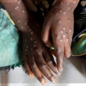 Africa Declares Mpox Public Health Emergency Amid Rapid Virus Spread